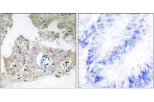 Immunohistochemistry analysis of paraffin-embedded human colon carcinoma tissue, using CIDEC Antibody. (CIDEC 抗体  (AA 189-238))