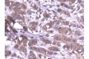 DAB staining on IHC-P; Samples: Human Breast cancer Tissue (PPP1CA 抗体  (AA 2-330))