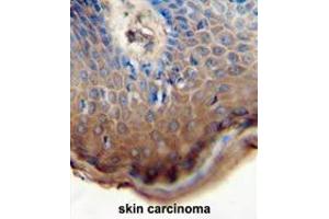 TJAP1 antibody (N-term) immunohistochemistry analysis in formalin fixed and paraffin embedded human skin carcinoma followed by peroxidase conjugation of the secondary antibody and DAB staining. (TJAP1 抗体  (N-Term))
