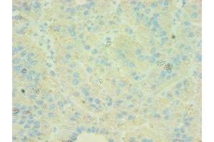 Immunohistochemistry of paraffin-embedded human liver cancer using ABIN7146169 at dilution of 1:100 (C4BPB 抗体  (AA 18-252))