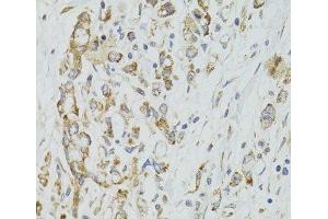 Immunohistochemistry of paraffin-embedded Human gastric cancer using DICER1 Polyclonal Antibody at dilution of 1:100 (40x lens). (DICER1 抗体)