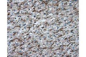 Immunohistochemical staining of paraffin-embedded Carcinoma of liver tissue using anti-ERCC1 mouse monoclonal antibody. (ERCC1 抗体)