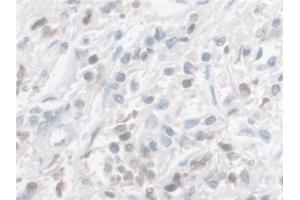 Detection of GAL9 in Human Prostate cancer Tissue using Polyclonal Antibody to Galectin 9 (GAL9) (Galectin 9 抗体  (AA 1-323))