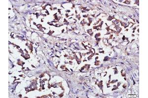 Paraformaldehyde-fixed, paraffin embedded human lung cancer, Antigen retrieval by boiling in sodium citrate buffer (pH6) for 15min, Block endogenous peroxidase by 3% hydrogen peroxide for 30 minutes, Blocking buffer (normal goat serum) at 37°C for 20min, Antibody incubation with RNF138 Polyclonal Antibody, Unconjugated  at 1:500 overnight at 4°C, followed by a conjugated secondary and DAB staining. (RNF138 抗体  (AA 90-130))