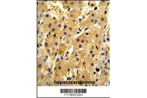 Formalin-fixed and paraffin-embedded human hepatocarcinoma reacted with HPD Antibody (N-term), which was peroxidase-conjugated to the secondary antibody, followed by DAB staining. (HPD 抗体  (N-Term))