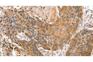 Immunohistochemistry of paraffin-embedded Human esophagus cancer using STX10 Polyclonal Antibody at dilution of 1:45 (Syntaxin 10 抗体)