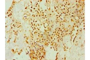 Immunohistochemistry of paraffin-embedded human breast cancer using ABIN7149658 at dilution of 1:100 (Seladin 1 抗体  (AA 227-516))
