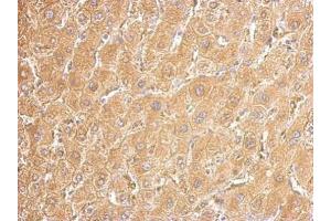 IHC-P Image UGDH antibody detects UGDH protein at cytosol on human hepatoma by immunohistochemical analysis. (UGDH 抗体)