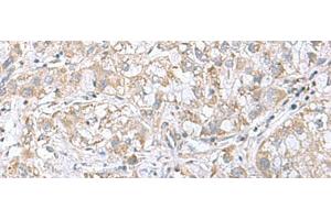 Immunohistochemistry of paraffin-embedded Human liver cancer tissue using CGB5 Polyclonal Antibody at dilution of 1:55(x200) (CGB5 抗体)