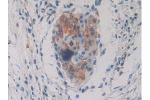 Detection of PKIg in Human Pancreatic cancer Tissue using Polyclonal Antibody to Protein Kinase Inhibitor Gamma (PKIg) (PKIG 抗体  (AA 1-76))