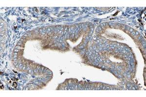 ABIN6279733 at 1/100 staining Human cervical cancer tissue by IHC-P. (RAB24 抗体  (Internal Region))