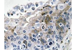 Immunohistochemistry analysis of IL-1B Antibody in paraffin-embedded human lung carcinoma tissue. (IL-1 beta 抗体)