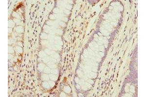 Immunohistochemistry of paraffin-embedded human colon cancer using ABIN7172974 at dilution of 1:100 (TMED1 抗体  (AA 35-190))