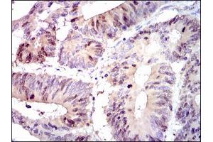 Figure5: Immunohistochemical analysis of paraffin-embedded colon cancer tissues using PBK mouse mAb with DAB staining. (PBK 抗体)