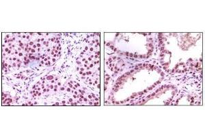 Immunohistochemical analysis of paraffin-embedded human lung carcinoma (left) and kidney carcinoma (right), showing nuclear localization using LSD1 mouse mAb with DAB staining. (LSD1 抗体)