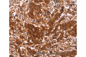 Immunohistochemistry of Human gastric cancer using HAS1 Polyclonal Antibody at dilution of 1:30