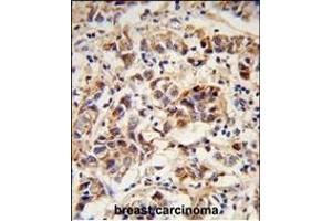 Formalin-fixed and paraffin-embedded human breast carcinoma reacted with SPRR1B Antibody (C-term), which was peroxidase-conjugated to the secondary antibody, followed by DAB staining.