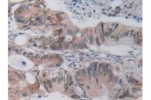 IHC-P analysis of Mouse Rectum Cancer Tissue, with DAB staining. (FLIP 抗体  (AA 210-460))