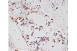 Immunohistochemistry of paraffin-embedded Human gastric cancer using HTATSF1 Polyclonal Antibody at dilution of 1:100 (40x lens). (HTATSF1 抗体)
