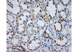 Immunohistochemical staining of paraffin-embedded Carcinoma of prostate tissue using anti-LIPG mouse monoclonal antibody. (LIPG 抗体)