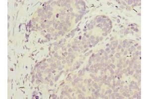 Immunohistochemistry of paraffin-embedded human gastric cancer using ABIN7175802 at dilution of 1:100 (WDR89 抗体  (AA 1-387))