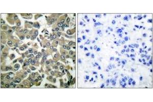 Immunohistochemistry analysis of paraffin-embedded human breast carcinoma, using WNK1 (Phospho-Thr58) Antibody. (WNK1 抗体  (pThr60))