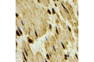 Immunohistochemical analysis of PP1 beta staining in human esophageal cancer formalin fixed paraffin embedded tissue section. (Serine/threonine-Protein Phosphatase PP1-beta Catalytic Subunit (PP1-BETA) 抗体)