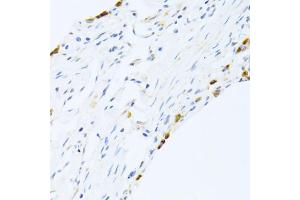 Immunohistochemistry of paraffin-embedded human lung using SFTPC antibody. (Surfactant Protein C 抗体)
