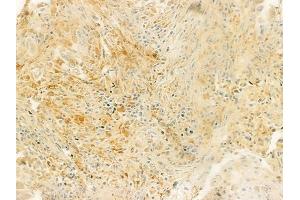 ABIN6263748 and ABIN6279343 at 1/100 staining human lung squamous cell carcinoma by IHC-P. (NT5C2 抗体  (Internal Region))