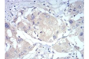 Immunohistochemical analysis of paraffin-embedded liver cancer tissues using FOXP3 mouse mAb with DAB staining. (FOXP3 抗体  (AA 297-431))