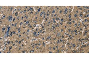 Immunohistochemistry of paraffin-embedded Human liver cancer using CORO1C Polyclonal Antibody at dilution of 1:60 (CORO1C 抗体)