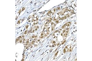 Immunohistochemistry of paraffin-embedded human breast cancer using SNRPD1 Rabbit pAb (ABIN7270363) at dilution of 1:50 (40x lens). (SNRPD1 抗体  (AA 1-100))