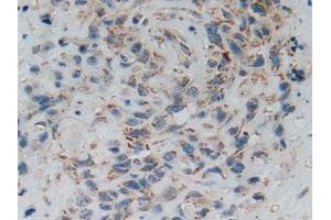 IHC-P analysis of Human Lung Cancer Tissue, with DAB staining. (SMAD5 抗体  (AA 210-464))