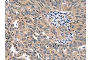 The image on the left is immunohistochemistry of paraffin-embedded Human ovarian cancer tissue using ABIN7191763(P2RY6 Antibody) at dilution 1/40, on the right is treated with synthetic peptide. (P2RY6 抗体)