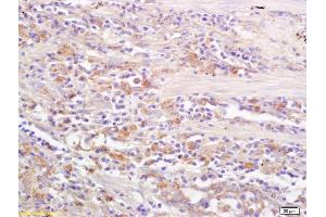 Formalin-fixed and paraffin embedded human lung carcinoma labeled with Rabbit Anti CD69/CLEC2C/AIM Polyclonal Antibody, Unconjugated (ABIN741150) at 1:200 followed by conjugation to the secondary antibody and DAB staining (CD69 抗体  (AA 101-199))