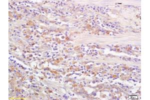 Formalin-fixed and paraffin embedded human lung carcinoma labeled with Rabbit Anti CD69/CLEC2C/AIM Polyclonal Antibody, Unconjugated (ABIN741150) at 1:200 followed by conjugation to the secondary antibody and DAB staining