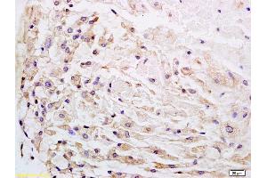 Formalin-fixed and paraffin embedded human gastric carcinoma labeled with Anti-Wnt1 Polyclonal Antibody, Unconjugated (ABIN733748) at 1:200 followed by conjugation to the secondary antibody and DAB staining. (WNT1 抗体  (AA 251-350))