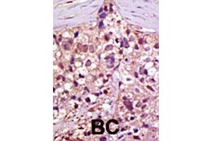 Formalin-fixed and paraffin-embedded human cancer tissue reacted with UBA1 polyclonal antibody  , which was peroxidase-conjugated to the secondary antibody, followed by AEC staining. (UBA1 抗体  (C-Term))