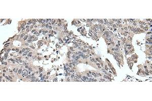 Immunohistochemistry of paraffin-embedded Human colorectal cancer tissue using TRIM23 Polyclonal Antibody at dilution of 1:55(x200) (TRIM23 抗体)