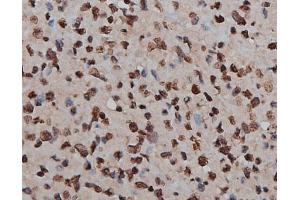 ABIN6269160 at 1/200 staining human lymph cancer tissue sections by IHC-P. (H2AFX 抗体)