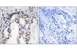 Immunohistochemistry analysis of paraffin-embedded human breast carcinoma, using Merlin (Phospho-Ser10) Antibody. (Merlin 抗体  (pSer10))