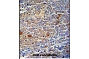 C9orf156 Antibody (C-term) (ABIN390925 and ABIN2841127) immunohistochemistry analysis in formalin fixed and paraffin embedded human skin carcinoma followed by peroxidase conjugation of the secondary antibody and DAB staining. (C9orf156 抗体  (C-Term))