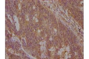 IHC image of ABIN7139936 diluted at 1:100 and staining in paraffin-embedded human colon cancer performed on a Leica BondTM system. (Neudesin 抗体  (AA 149-167))
