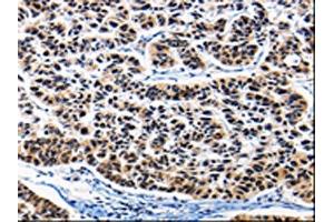 The image on the left is immunohistochemistry of paraffin-embedded Human lung cancer tissue using ABIN7189819(AP1B1 Antibody) at dilution 1/25, on the right is treated with synthetic peptide.