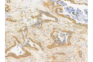 ABIN6262407 and ABIN6276441 at 1/100 staining human pancreatic carcinoma by IHC-P. (GRP94 抗体  (C-Term))