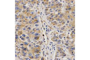 Immunohistochemistry of paraffin-embedded human liver cancer using VAPB Antibody. (VAPB 抗体)