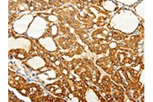 The image on the left is immunohistochemistry of paraffin-embedded Human thyroid cancer tissue using ABIN7190727(FZD6 Antibody) at dilution 1/60, on the right is treated with synthetic peptide. (FZD6 抗体)
