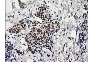 Immunohistochemical staining of paraffin-embedded Adenocarcinoma of Human breast tissue using anti-PRKCE mouse monoclonal antibody. (PKC epsilon 抗体)