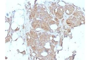Formalin-fixed, paraffin-embedded human breast carcinoma stained with Major Vault Protein antibody (1032).
