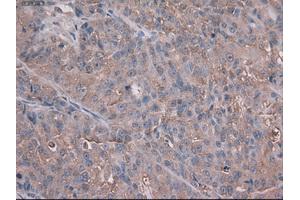 Immunohistochemical staining of paraffin-embedded Adenocarcinoma of colon using anti-Trim33 (ABIN2452534) mouse monoclonal antibody. (TRIM33 抗体  (AA 887-1046))